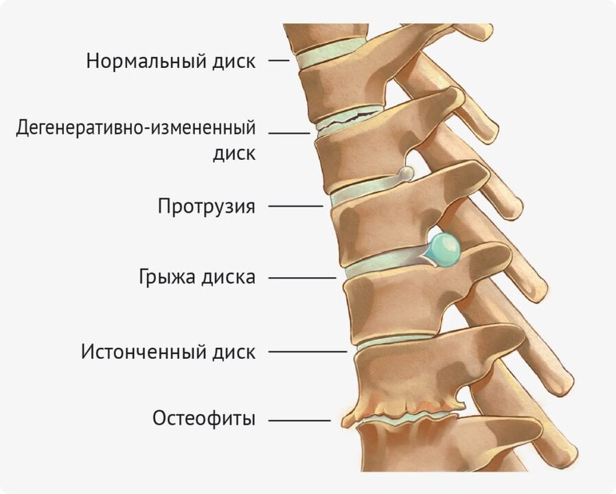 Lemez deformáció az ágyéki osteochondrosishoz