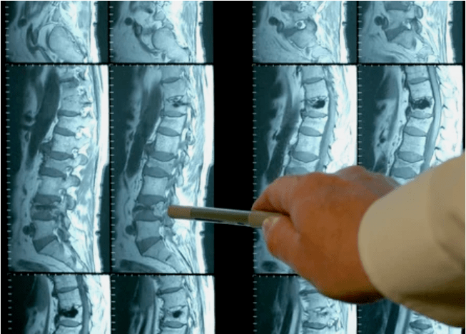 A gerinc osteochondrosis fajtái