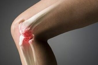 A térdízület arthrosis a porcszövet léziója