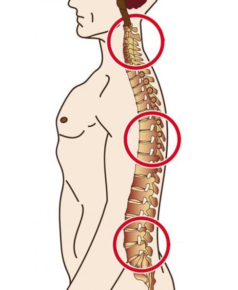 gerinci osztályok, amelyekben az osteochondrosis bekövetkezik