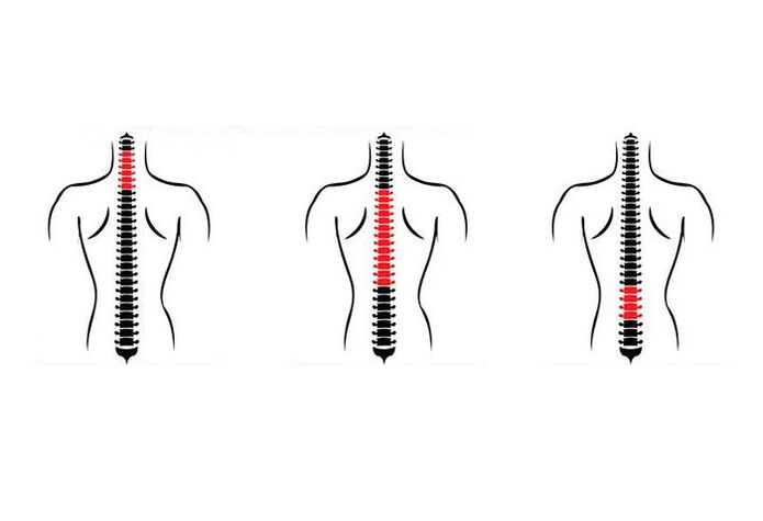 Hogyan nyilvánul meg az osteochondrosis