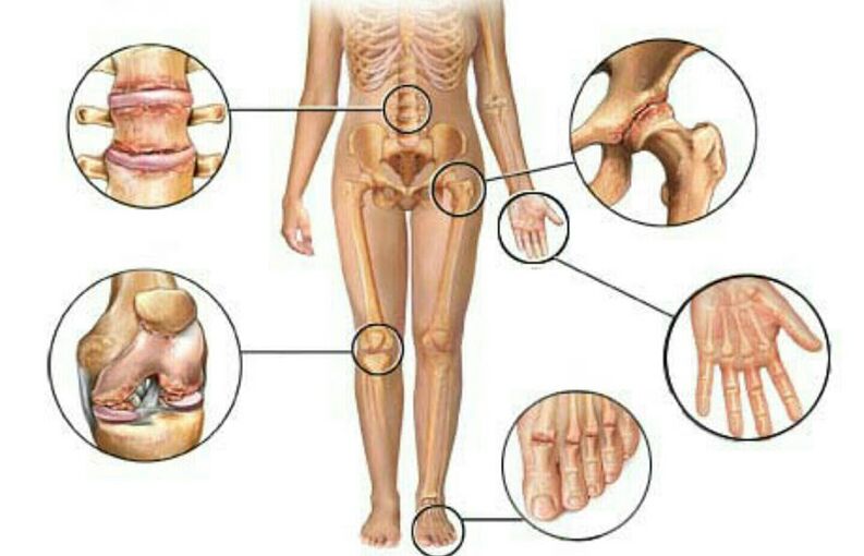 az arthrosis típusai és fokozatai