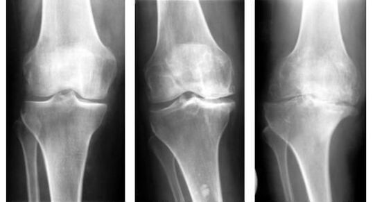 A térd arthrosisának azonosításakor kötelező diagnosztikai intézkedés egy röntgen