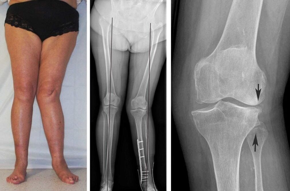 A térdízületek előrehaladott arthrosisa röntgenfelvétel nélkül is jól látható vizuálisan